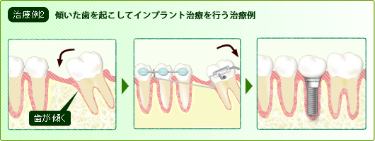 傾いた歯を起こす（整直）による治療例