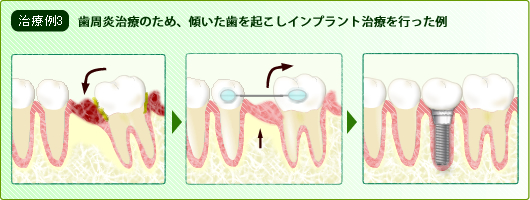 傾いた歯を起こす（整直）による治療例